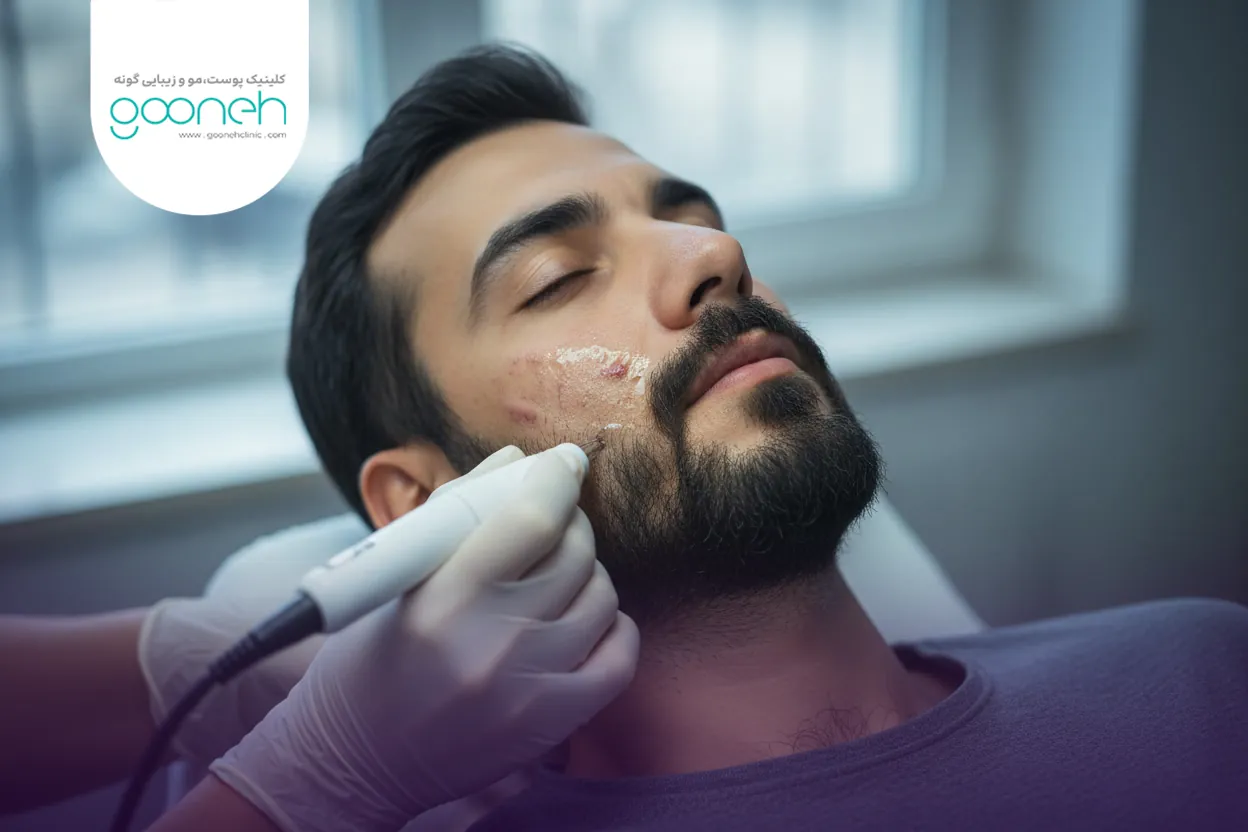 Treatment for acne scars and facial pitting 1 روش های کلینیکی درمان جای جوش و چاله های صورت