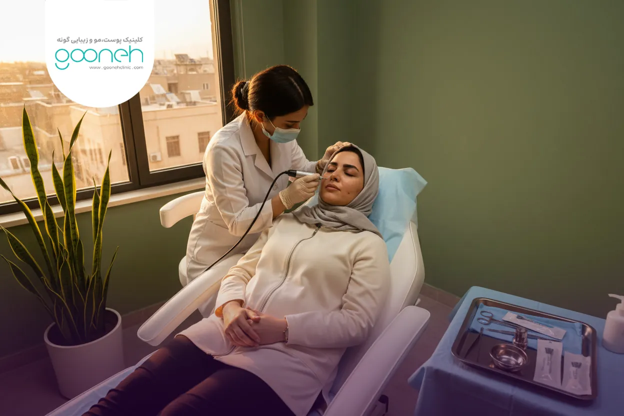 Treatment of pitted acne scars with microneedling 1 مراحل درمان فرورفتگی جای جوش با میکرونیدلینگ