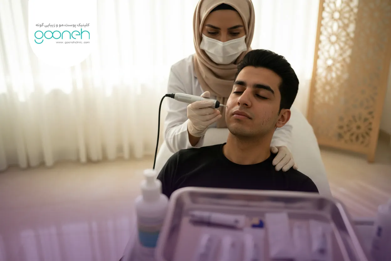 Treatment of pitted acne scars with microneedling درمان فرورفتگی جای جوش با میکرونیدلینگ