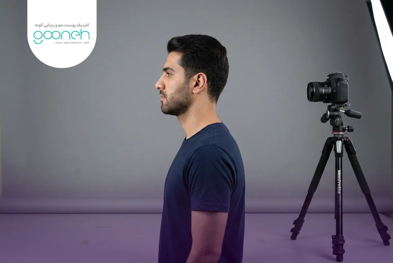 HIFU How many sessions does it take for a double chin 3 تاثیر تعداد جلسات هایفو غبغب بر هزینه درمان